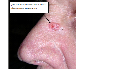 Базалиома кожи: лечение и удаление базальноклеточного рака в Одессе