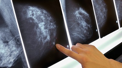 К 2050 году женщины перестанут умирать от рака груди