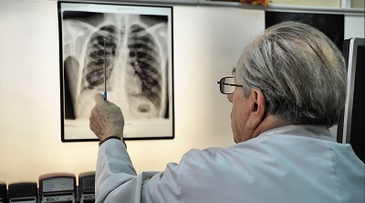 Новый способ лечения рака легких