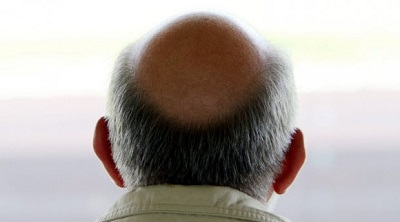 Облысение - повод показаться врачу-онкологу